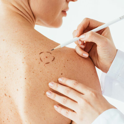 4 Healthy Changes That Reduce the Risk of Melanoma