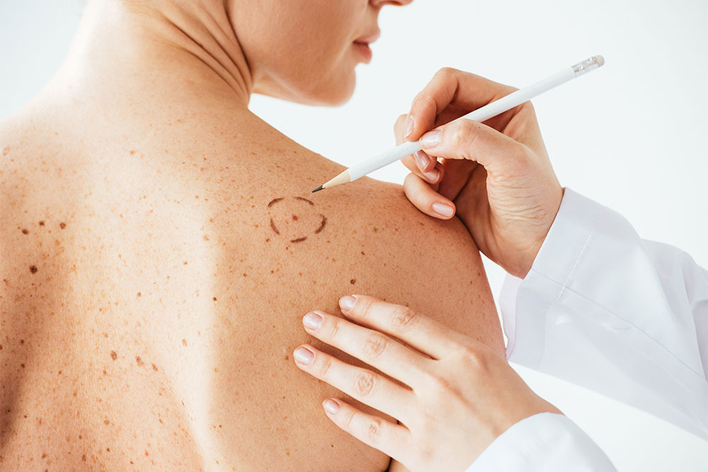 4 Healthy Changes That Reduce the Risk of Melanoma