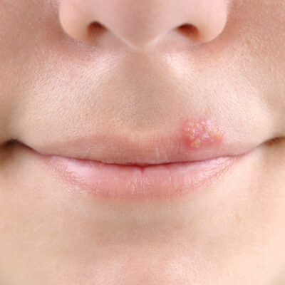 5 Common Causes of Cold Sore Outbreaks