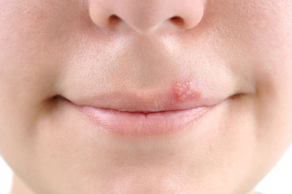 5 Common Causes of Cold Sore Outbreaks