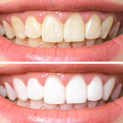 Top 6 Teeth Whitening Toothpastes