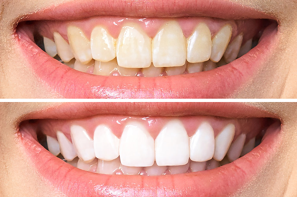 Top 6 Teeth Whitening Toothpastes